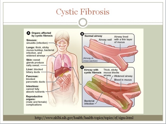 cystic fib